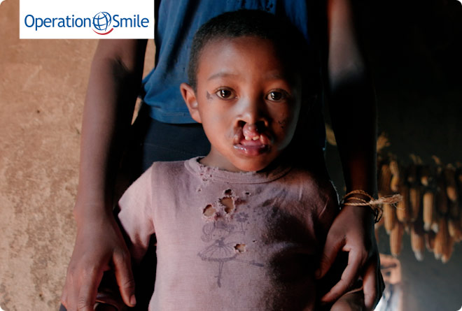 A young boy with a cleft palate waiting for surgery from the Operation Smile medical team